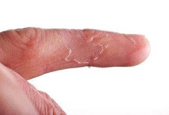 冬季手脚干裂起皮 也可能与这5因素有关