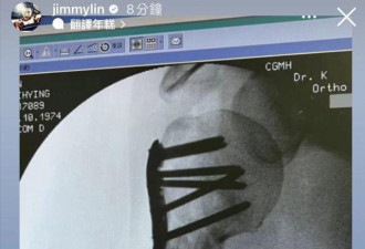 林志颖手臂X光片：骨头插10颗钉子 说不痛是骗人