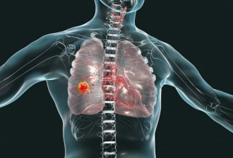 医院群发出错 数百患者收到“肺癌确诊”