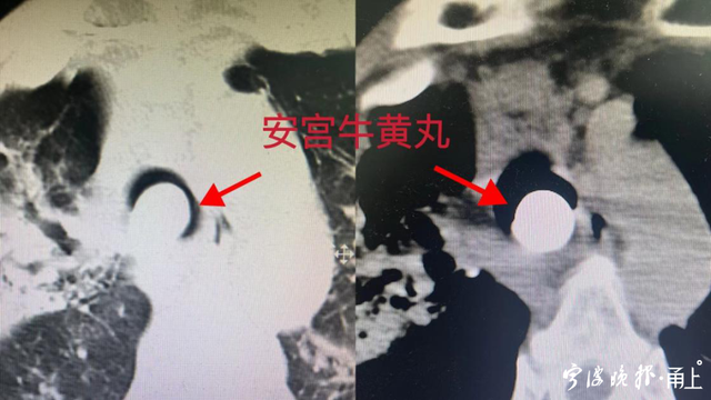 错服“神药”,浙江一老人氧饱和度掉到80%!医生提醒:这样用会适得其反|浙江队_新浪新闻