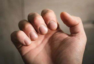 心脏病变 手指可能出现3个“异常”