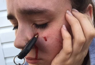 安省女子被朋友扔来的车钥匙刺伤脸部，扎进一英寸半