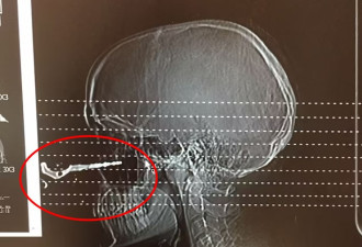 安省女子被朋友扔来的车钥匙刺伤脸部，扎进一英寸半