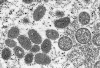 多伦多增4例猴痘 一天内确诊