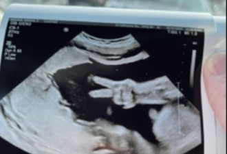宝妈产检惊见腹中胎儿这动作，医惊