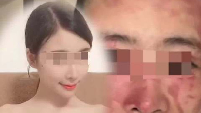 新浪热榜】被丈夫泼硫酸毁容女子发声