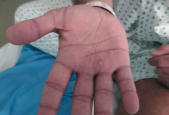 台湾地区首次出现本地猴痘确诊病例,为两名男子