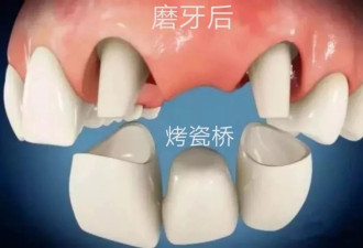 有良知的牙科医生 都在实名反对这种“牙科治疗术”