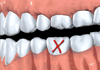 缺牙很久了 还有必要继续种植牙吗？