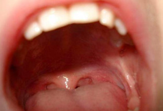 舌头“锯齿状破皮” 医叹：罹癌了 致死率很高