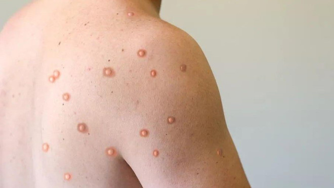 香港新增一宗猴痘确诊个案曾数次前往广东_凤凰网资讯_凤凰网