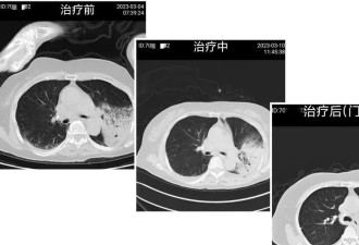 77岁阿婆呼吸衰竭，上海多家医院收到类似病例