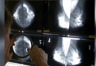 美CDC：年龄、家族...都会提高乳癌机率