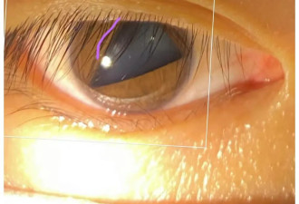 瞳孔突然变成三角形，是新冠后遗症？
