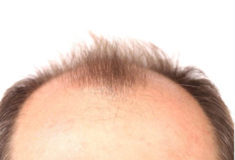 在痣中发现负责头发生长的分子 或将治愈秃头