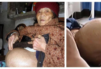 91岁阿婆跌倒发现怀孕！肚里有完整胎儿