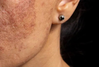 皮肤出现3种异常 可能是癌症来临