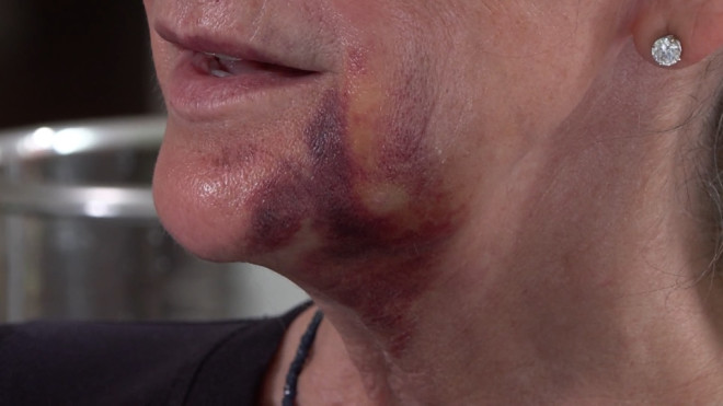 This photo shows some of the injuries to a West Vancouver woman who says she was attacked after getting off of a bus. 