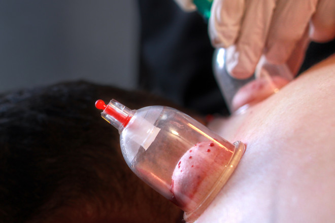 wet cupping and/or microneedling/derma rolling services