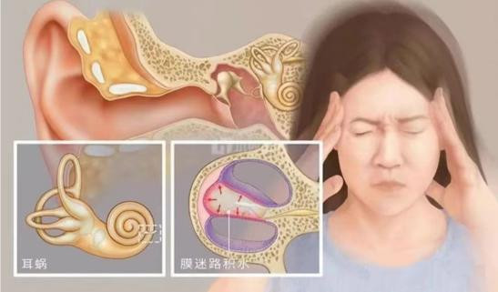 耳水不平衡”是怎么回事?这个病严重吗?_手机新浪网