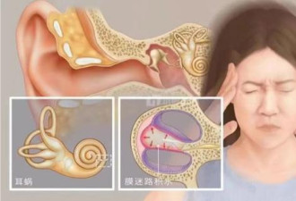 “耳水不平衡”是怎么回事？这个病严重吗？