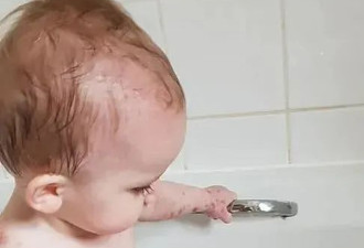 1岁女婴浑身长紫色疹子 急诊4天才脱险！