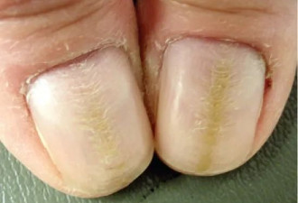指甲月牙小、有竖纹，就是不健康？错！
