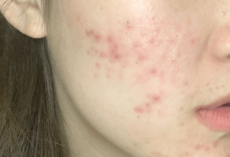 脸上有痘痘很困扰 如何科学护肤？