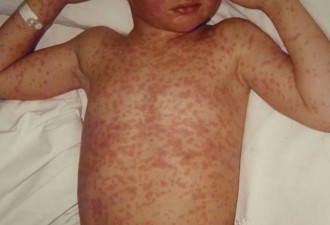 加卫生部警告：2人确诊严重传染病麻疹