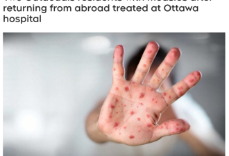 加卫生部警告：2人确诊严重传染病麻疹