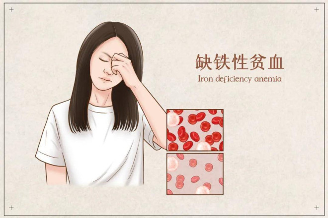 缺铁性贫血究竟是怎么回事?如何预防?_补充