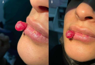 慎入！孕妇吃饭咬到嘴唇 竟长成肿瘤达4个月 医生:罕见