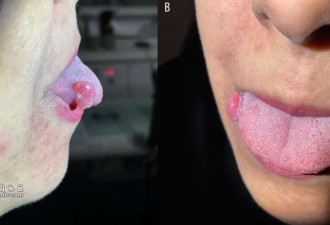 慎入！孕妇吃饭咬到嘴唇 竟长成肿瘤达4个月 医生:罕见