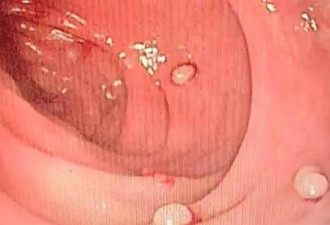 腹泻2个月…肠内惊见“20颗珍珠” 医揭恐怖后果