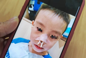 长沙22名孩子被“消鼻甲”治鼻炎:鼻腔糜烂