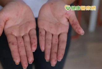 大人也会感染肠病毒 27岁女双手布满红疹