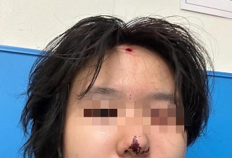 中国留学生美国感恩节额头遭流弹击中，当事人：警察说是弹珠枪