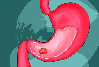 胃病变成“胃癌”前，曾用5个症状提醒你