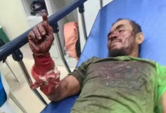 菲律宾男子咬死3米巨蟒：遭蟒蛇咬伤缠身后...