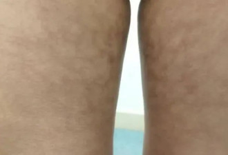 腿上长出大片红斑 严重的可能演变成癌症