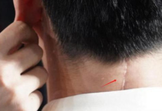 沈腾颈椎手术高清疤痕照曝光 颈后开刀延至背部