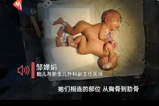 连体姐妹花的悲情一生：天生貌美，臀部相连，各自有男友，不幸沦为赚钱工具…_手机搜狐网