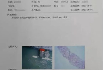 广东11岁男孩被喂成肝硬化！天天吃这个