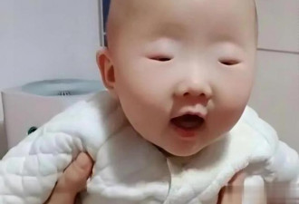 娃出生“没眼睛” 父母急要哭 医生却笑了