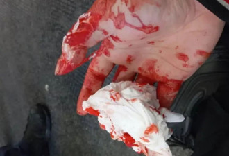 怒了！36岁华人遭一元店黑人员工嫌弃英文差，被殴打至颅内出血！