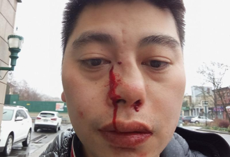 怒了！36岁华人遭一元店黑人员工嫌弃英文差，被殴打至颅内出血！