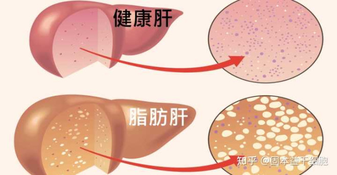 男子节食1 个月瘦10 公斤得脂肪肝,为什么节食减肥会得脂肪肝?关于减肥有哪些注意事项? - 知乎