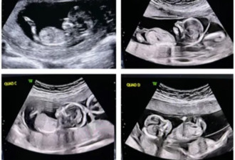 阿尔伯塔省年轻夫妇将迎来四胞胎：全省第六例