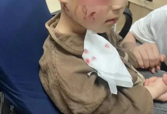 悲剧！河南3岁男童被恶狗咬伤，打了疫苗仍离世