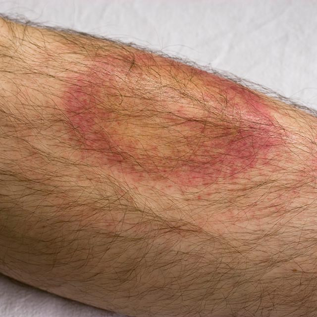 Lyme disease rash